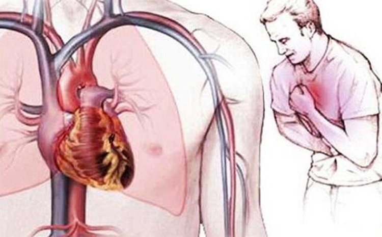 Hội chứng mạch vành cấp là một bệnh lý tim mạch cực kỳ nguy hiểm